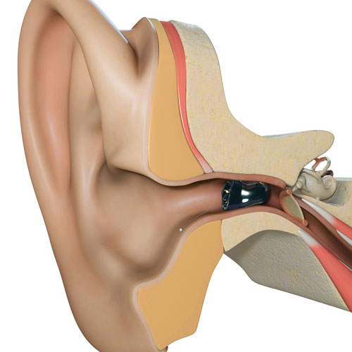 Invisible-In-The-Canal (IIC) shown in the ear